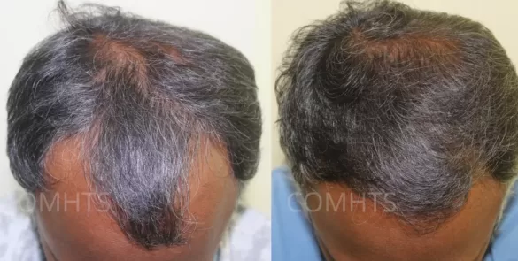 PRP Treatment for Hair - Before & After - PRP for Hair
