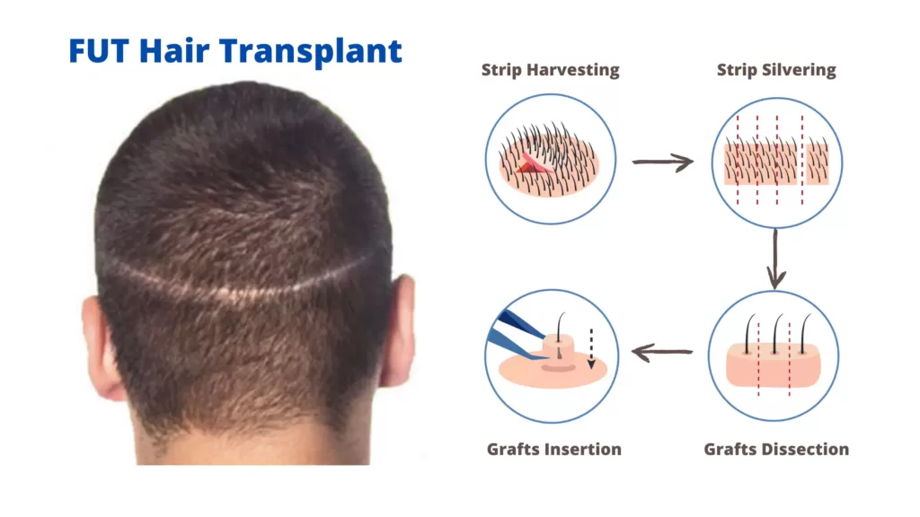 fut hair transplant