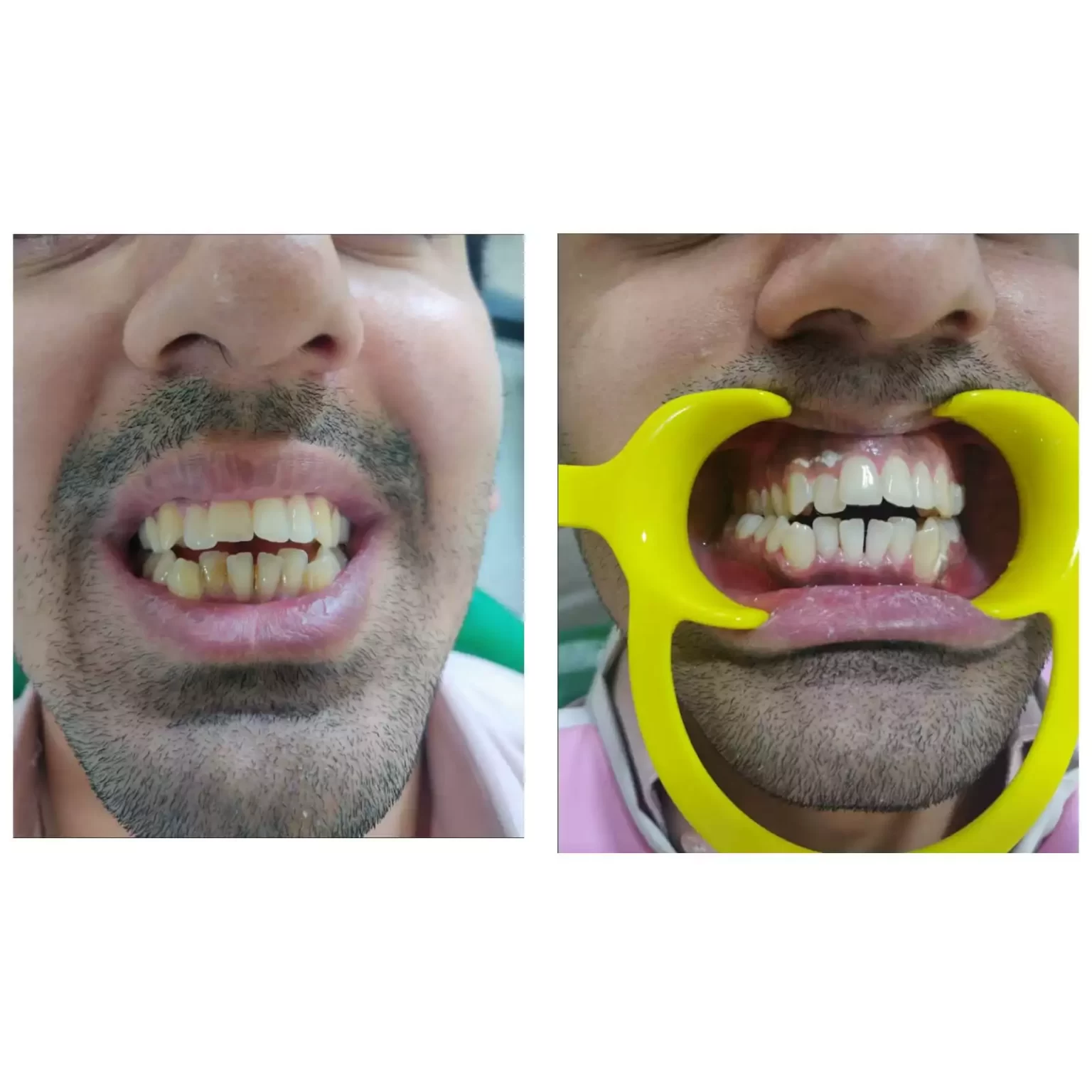 Teeth hitening Before and after dental cleaning